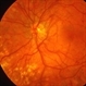 Proliferative Diabetic Retinopathy with NVD Proliferative Diabetic Retinopathy with NVD