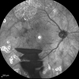 Proliferative Diabetic Retinopathy Proliferative Diabetic Retinopathy