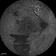 Proliferative Diabetic Retinopathy Proliferative Diabetic Retinopathy