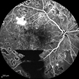 Proliferative Diabetic Retinopathy Proliferative Diabetic Retinopathy