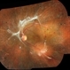 Tractional Retinal Detachment,  PDR Tractional Retinal Detachment,  PDR