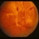 PDR with fibrous proliferation PDR with fibrous proliferation