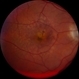 Pigment Epithelial Detachment Pigment Epithelial Detachment