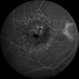 Pigment Epithelial Detachment  late FA with small occult CNV Pigment Epithelial Detachment  late FA with small occult CNV