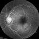 Presumed Ocular Histoplasmosis Syndrome with Choroidal Neovascularization Presumed Ocular Histoplasmosis Syndrome with Choroidal Neovascularization