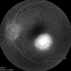 Presumed Ocular Histoplasmosis Syndrome with Choroidal Neovascularization Presumed Ocular Histoplasmosis Syndrome with Choroidal Neovascularization