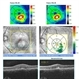 Presumed Ocular Histoplasmosis Syndrome with Choroidal Neovascularization Presumed Ocular Histoplasmosis Syndrome with Choroidal Neovascularization