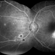 Presumed Ocular Histoplasmosis Syndrome Presumed Ocular Histoplasmosis Syndrome