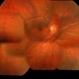 Post Choroidal Folds OD Post Choroidal Folds OD