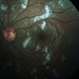 Purtscher's Retinopathy Purtscher's Retinopathy
