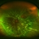 Retinal Detachment with Proliferative Vitreoretinopathy