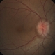 Papilledema