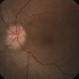 Papilledema