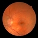 Papilledema