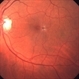 Type 2 Parafoveal Telangiectasia Type 2 Parafoveal Telangiectasia