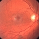 Type 2 Parafoveal Telangiectasia Type 2 Parafoveal Telangiectasia