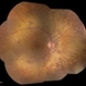 Peripheral Retinal Degeneration