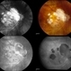 Myopic Maculoscheisis