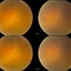 Retinal Detachment with Retinal Hole (3-D)