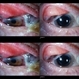 Conjunctival Tumor