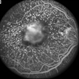Basal Laminar Drusen with Vitelliform Detachment Basal Laminar Drusen with Vitelliform Detachment
