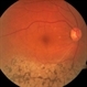 Sector Retinitis Pigmentosa Sector Retinitis Pigmentosa