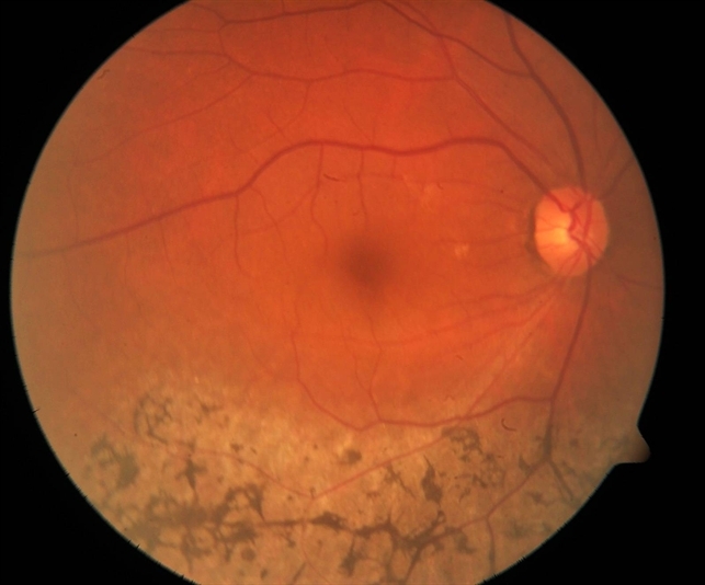 Sector retinitis pigmentosa retina image bank