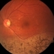 Sector Retinitis Pigmentosa Sector Retinitis Pigmentosa