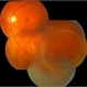 Retinoschisis