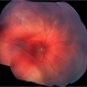 X-linked Retinoschisis (XLRS) X-linked Retinoschisis (XLRS)