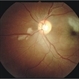 Bilateral Simultaneous Macular Infarction
