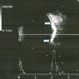 Choroidal Osteoma