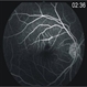 Bilateral Simultaneous Macular Infarction