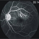 Bilateral Simultaneous Macular Infarction