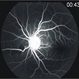 Bilateral Simultaneous Macular Infarction