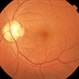 Pit Macular Syndrome Pit Macular Syndrome