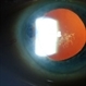 Polychromatic Cataract (Christmas Tree Cataract)