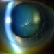 Polychromatic Cataract (Christmas Tree Cataract)
