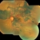 Polypoidal Choroidal Vasculopathy Polypoidal Choroidal Vasculopathy