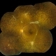 Post-Op Vitrectomy With Membrane Stripping and Laser