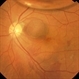 Submacular Hemorrhage After Pneumatic Displacement Submacular Hemorrhage After Pneumatic Displacement