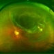 Rhegmatogeous Retinal Detachment