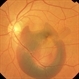 Submacular Hemorrhage Before Treatment Submacular Hemorrhage Before Treatment