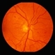 Proliferative Diabetic Retinopathy Proliferative Diabetic Retinopathy