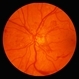Proliferative Diabetic Retinopathy Proliferative Diabetic Retinopathy