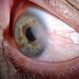 Pterygium