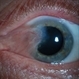 Pterygium