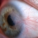 Pterygium