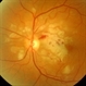 Purtscher Retinopathy Purtscher Retinopathy