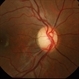 Pale Optic Atrophy Pale Optic Atrophy